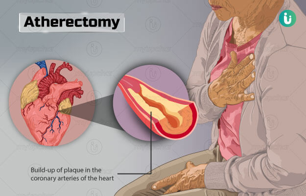 Atherectomy-strategy-updates