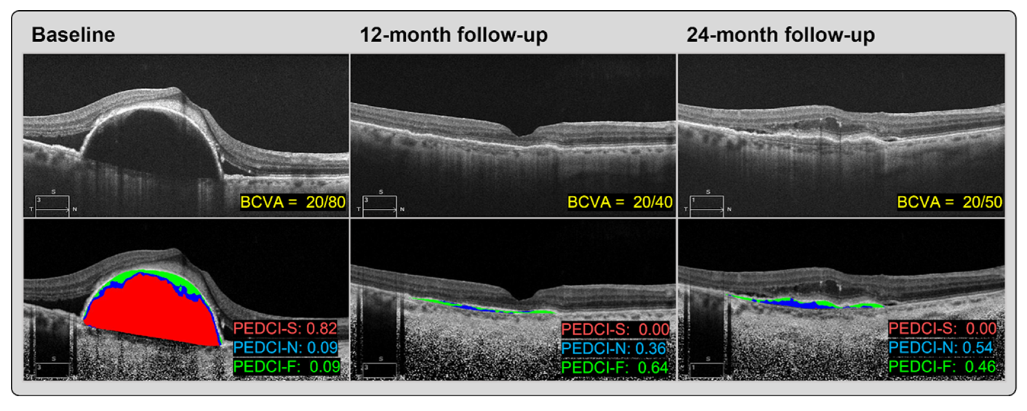 Optical-coherence-tomography