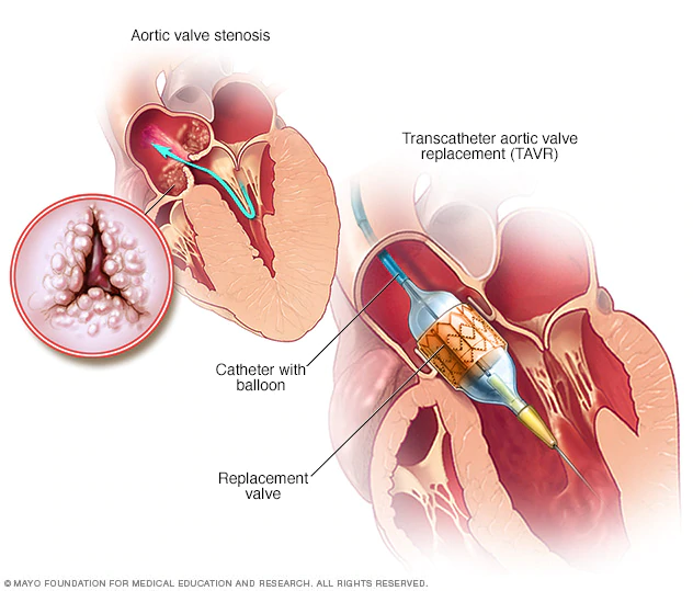 TAVR-Program-Standards-Policy-Impact