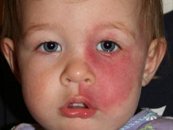 Sturge-Weber Syndrome